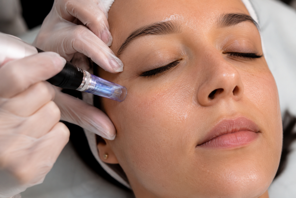 Professionelle Microneedling-Behandlung im Gesicht mit einem modernen Microneedling-Gerät zur Anregung der Hauterneuerung.